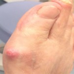 Tratamiento de Juanetes en Asturias Otros tratamientos juanetes